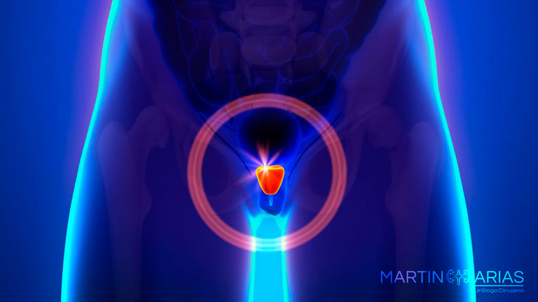 prostata_tratamiento_urologo_caracas_martin_arias